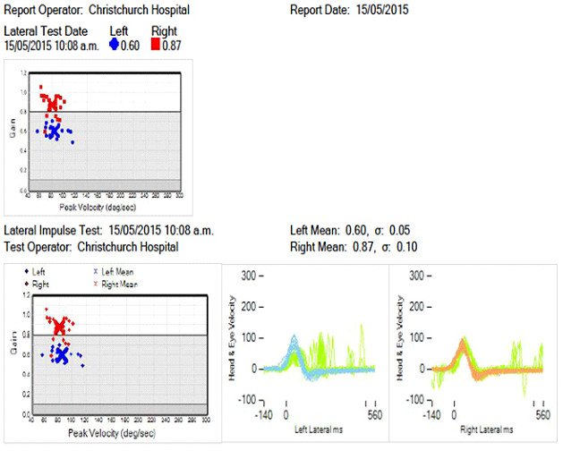 Video head impulse test results